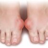 Tổng hợp những nguyên nhân và triệu chứng bệnh Gout