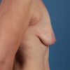 Làm sao để ngực không bị chảy xệ?