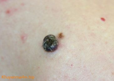 Những người có nốt ruồi nên đề phòng ung thư da