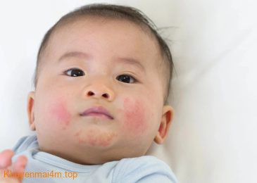 Trẻ bị viêm da cơ địa có những dấu hiệu nào?
