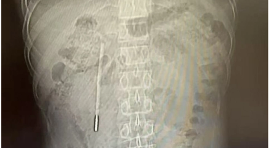 Suýt thủng ruột vì nhiệt kế thủy ngân ‘ngủ quên’ 20 năm trong bụng