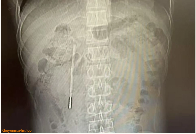 Suýt thủng ruột vì nhiệt kế thủy ngân ‘ngủ quên’ 20 năm trong bụng