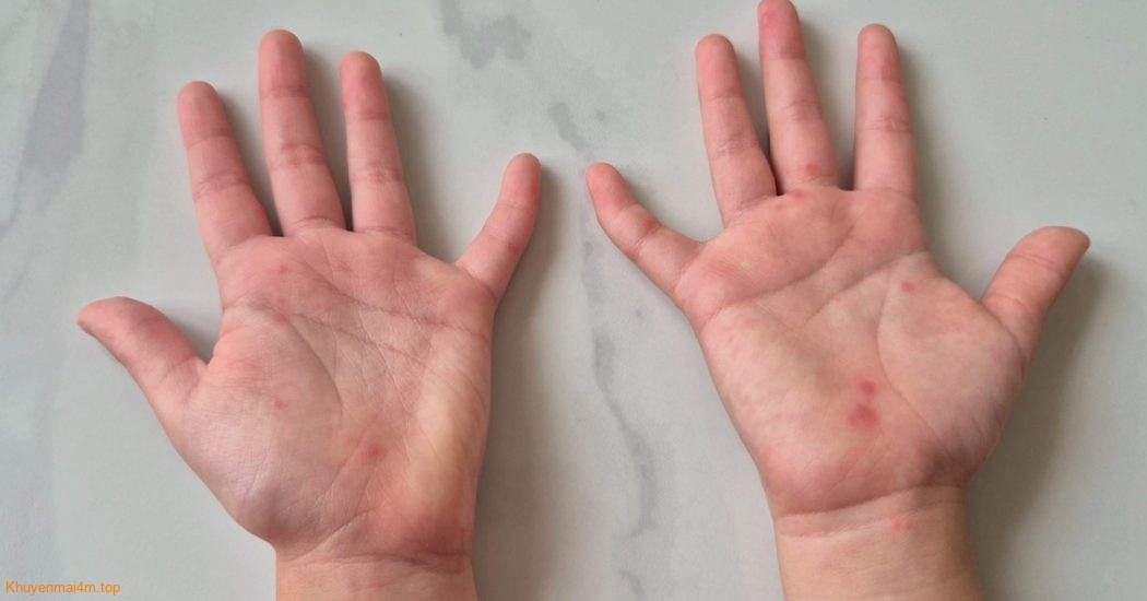 Đừng bỏ lỡ “giờ vàng” cứu trẻ mắc bệnh tay chân miệng