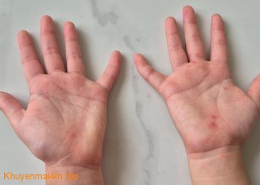 Đừng bỏ lỡ “giờ vàng” cứu trẻ mắc bệnh tay chân miệng