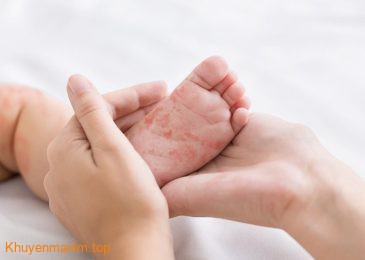 Trẻ dị ứng đạm sữa bò thì cha mẹ nên làm gì?