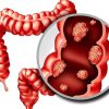 Dấu hiệu ung thư ruột nhiều người nhầm tưởng rối loạn tiêu hóa