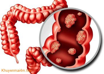 Dấu hiệu ung thư ruột nhiều người nhầm tưởng rối loạn tiêu hóa